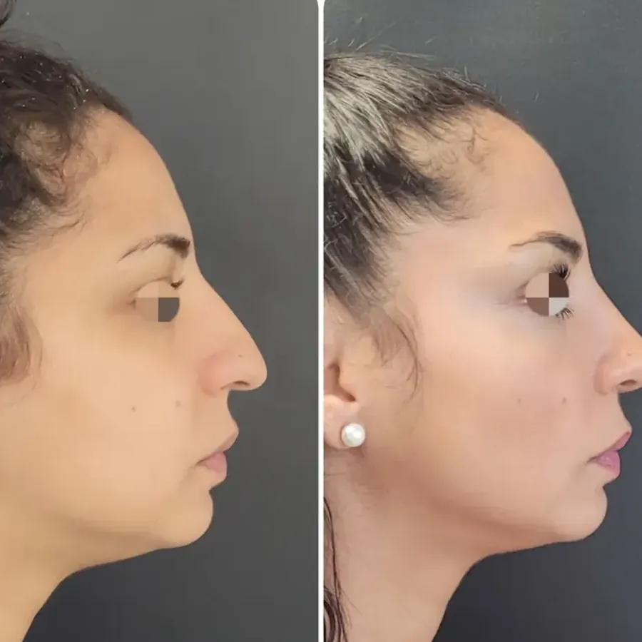 Avant/après Rhinoplastie primaire, résultat à 6 mois, Dr Nathanel Edery, Clinique Spontini Paris 16e (vue 1)