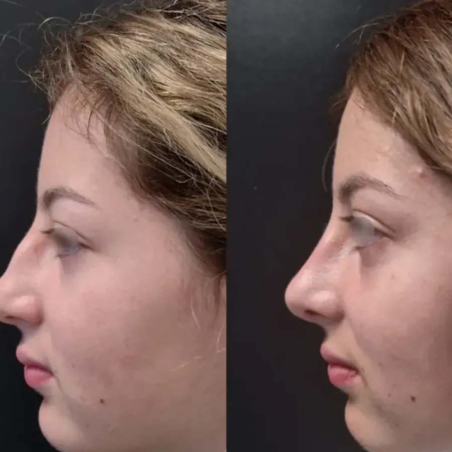 Avant/après Rhinoplastie, résultat à 3 mois, Dr Nathanel Edery, Clinique Spontini Paris 16e (vue 1)