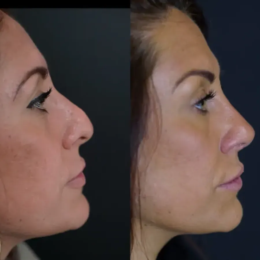 Avant/après Rhinoplastie secondaire, résultat à 3 mois, Dr Nathanel Edery, Clinique Spontini Paris 16e (vue 1)