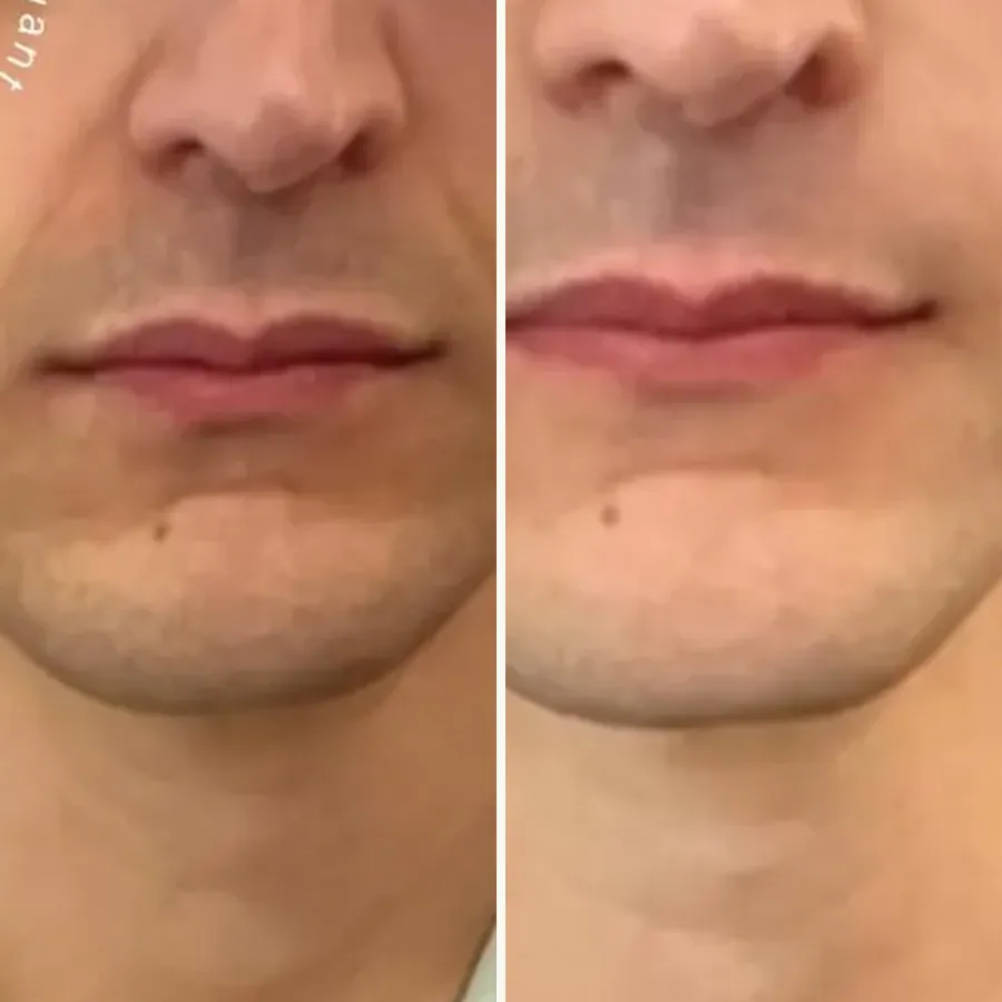 Avant/après Sillons chez l’homme, Dr Daniel Alimi, Clinique Spontini Paris 16e