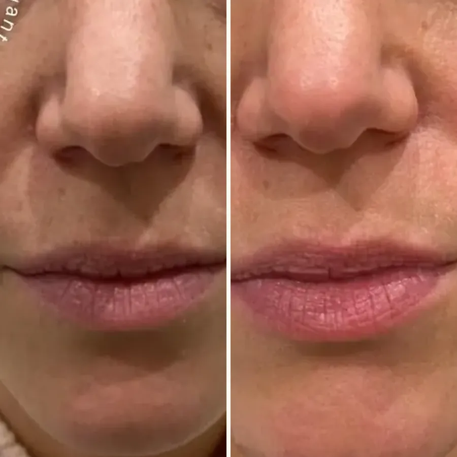 Avant/après Sillons nasogéniens, 1 ml d'acide hyaluronique, Dr Daniel Alimi, Clinique Spontini Paris 16e