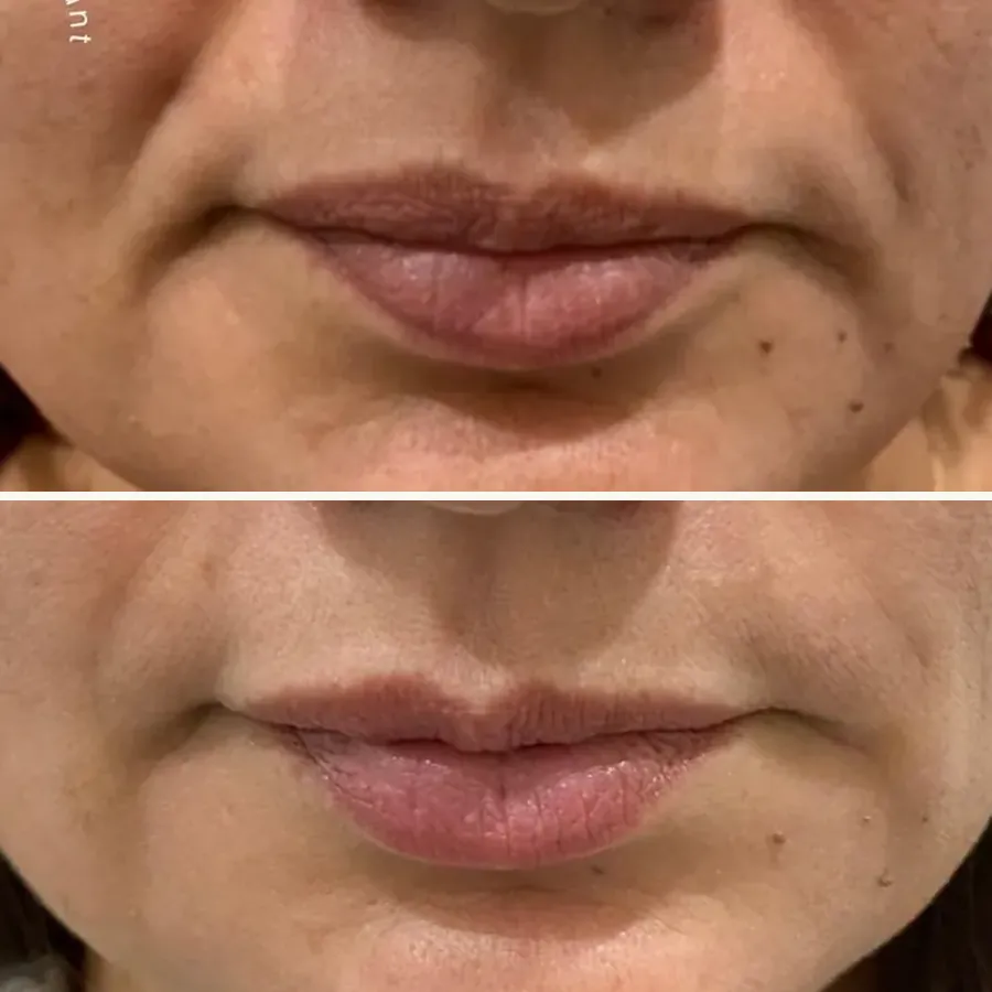 Avant/après Sillons nasogéniens, Dr Daniel Alimi, Clinique Spontini Paris 16e