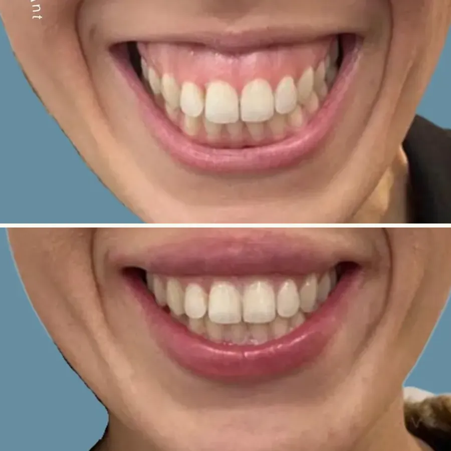 Avant/après Sourire gingival, Dr Daniel Alimi, Clinique Spontini Paris 16e