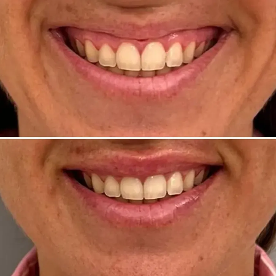 Avant/après Sourire gingival, patiente de 28 ans, Dr Daniel Alimi, Clinique Spontini Paris 16e