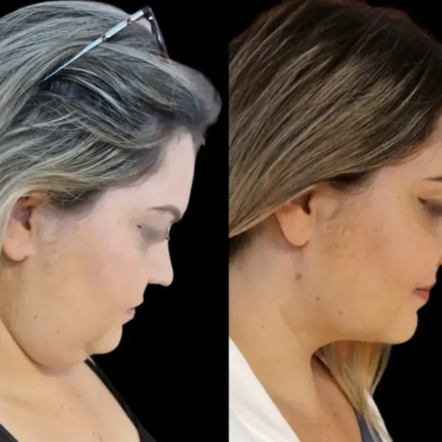 Avant/après Traitement du double menton, Dr Nathanel Edery, Clinique Spontini Paris 16e (vue 1)