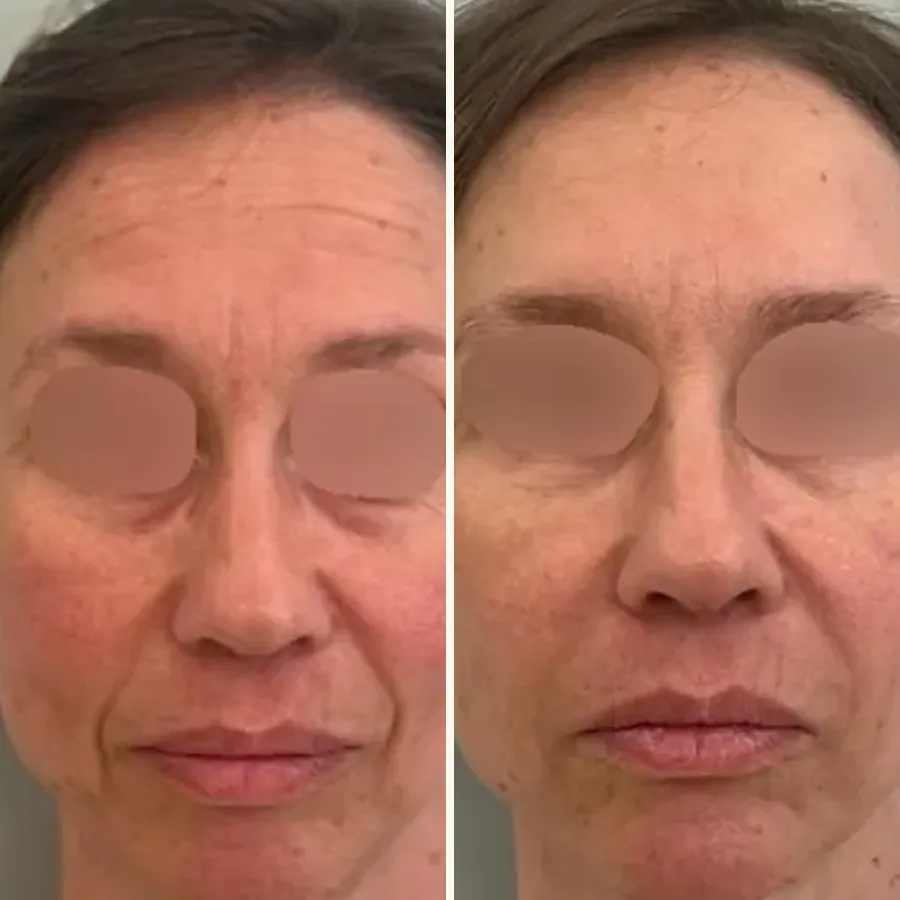 Avant/après Traitement global du visage, Dr Daniel Alimi, Clinique Spontini Paris 16e