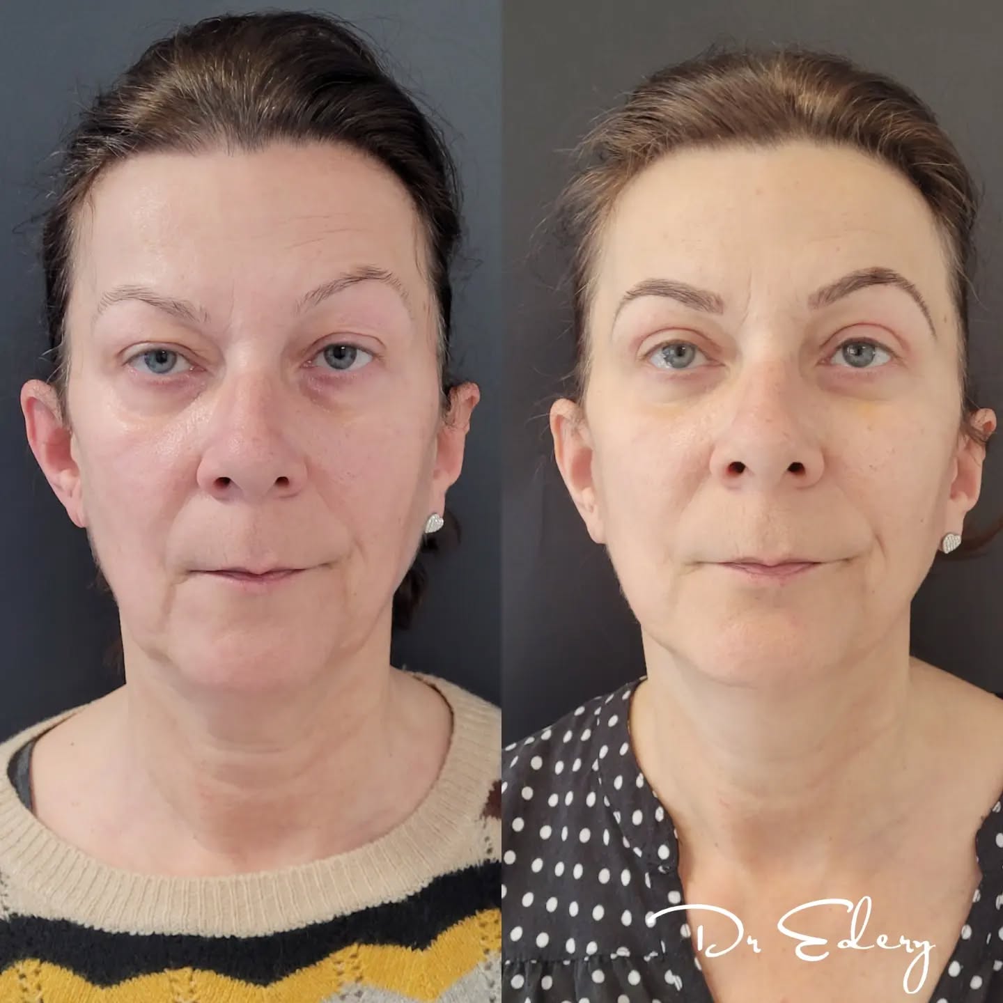 Cas Dr Edery : CdBlftLs2i1 photo 3/3