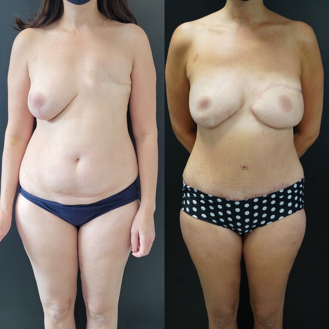 Reconstruction mammaire après mastectomie (mutation BRCA)