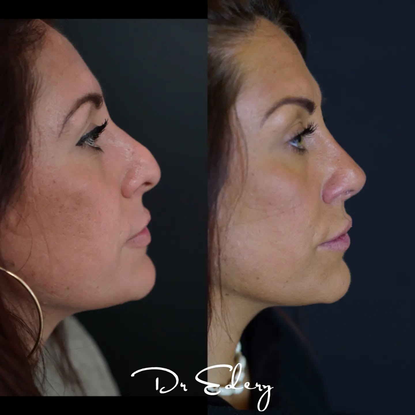 Rhinoplastie secondaire, résultat à 3 mois