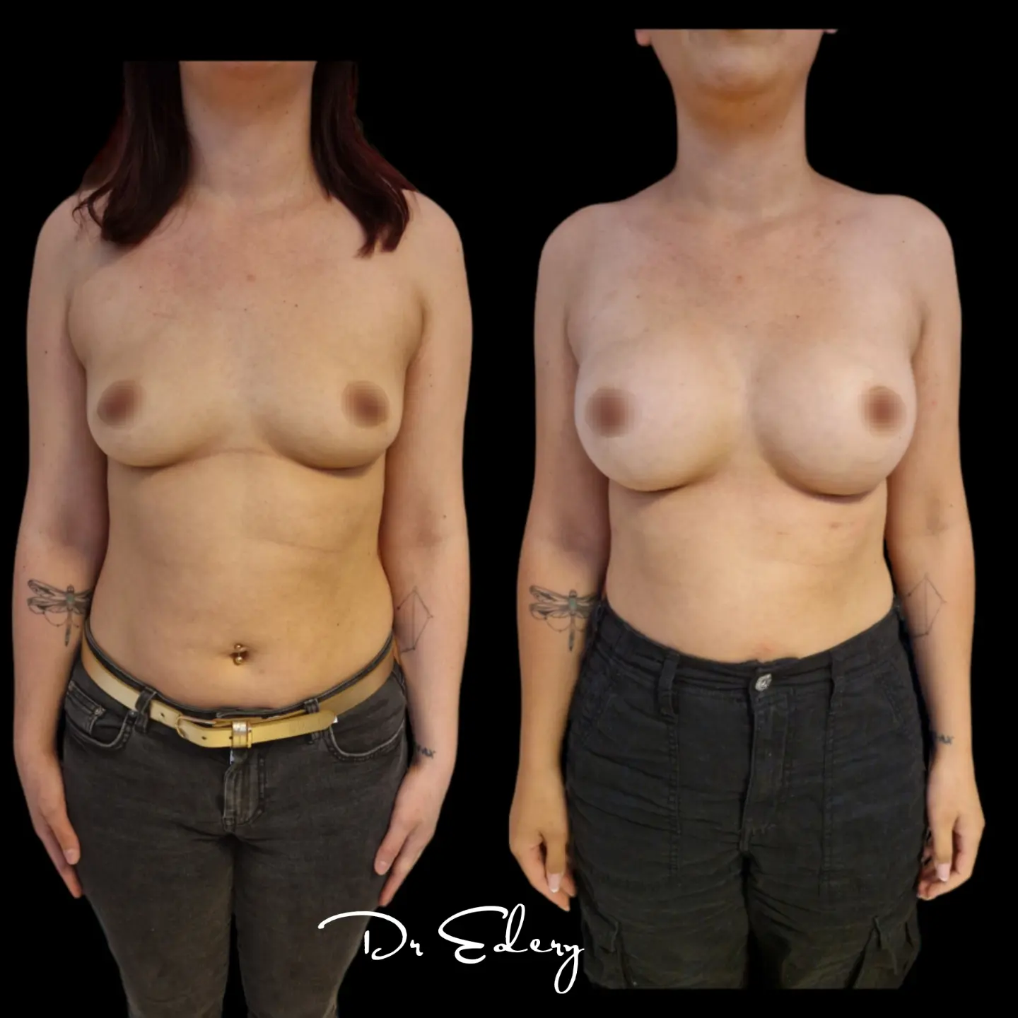 Augmentation mammaire par implants dual plan, résultat 3 mois, Dr Edery